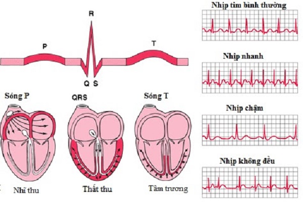 Ðau tim thầm lặng