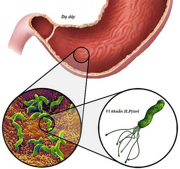 Dùng thuốc đúng cách trị viêm loét dạ dày do H.pylori
