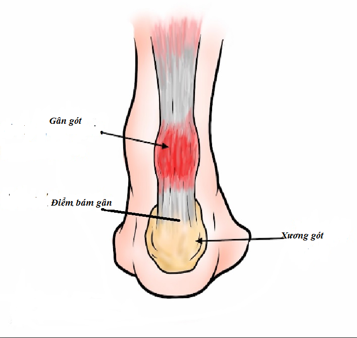 Viêm điểm bám gân 