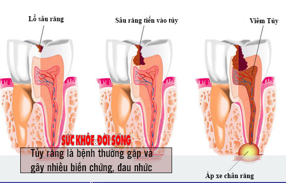 Lấy tủy về răng rất đau