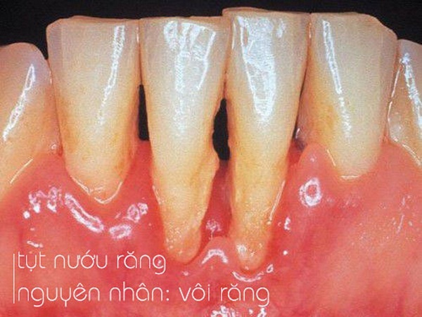 Có thuốc nào chữa răng lung lay không?