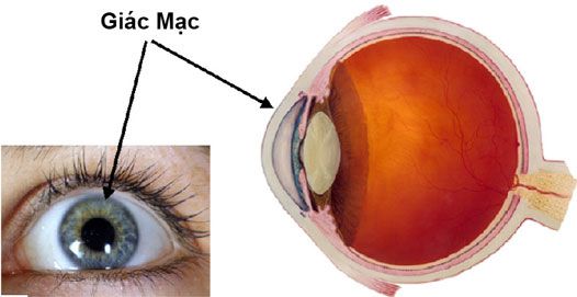 Viêm giác mạc sợi 