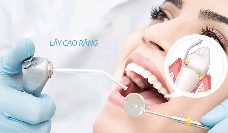 Cao răng - thủ phạm gây bệnh nha chu