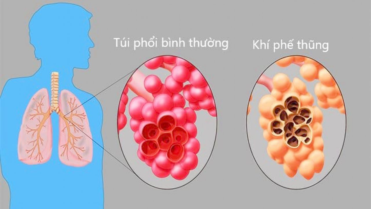 Bệnh khí phế thũng