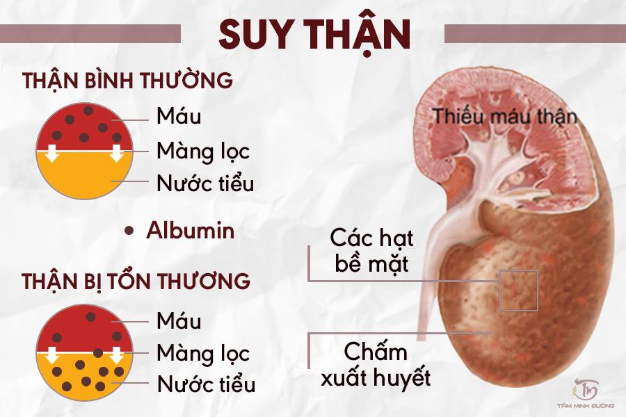 Tập luyện giúp kiểm soát suy thận