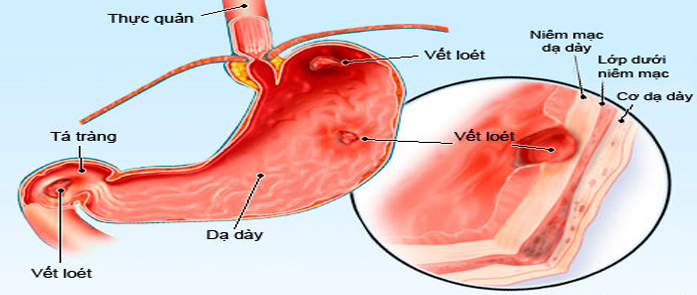 Thuốc tốt từ dạ dày nhím