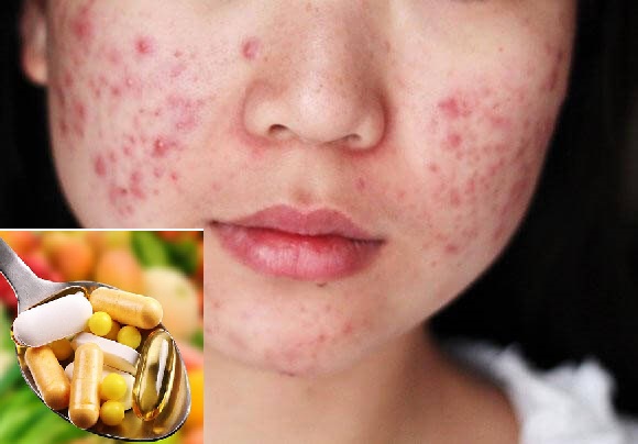 Khoáng chất cần bổ sung cho người bị mụn trứng cá