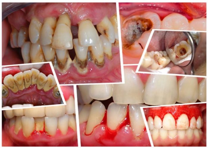 Cao răng và bệnh lý liên quan