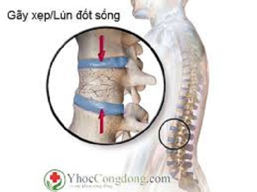 Những tiến bộ trong điều trị xẹp đốt sống lưng do loãng xương