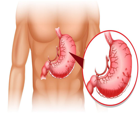 Khi dạ dày không khỏe