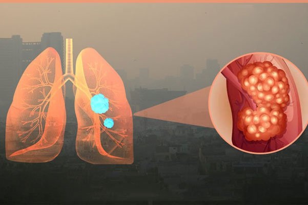 Ô nhiễm không khí gây các bệnh hô hấp