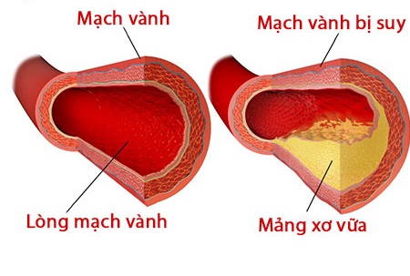 Thuốc điều trị suy mạch vành