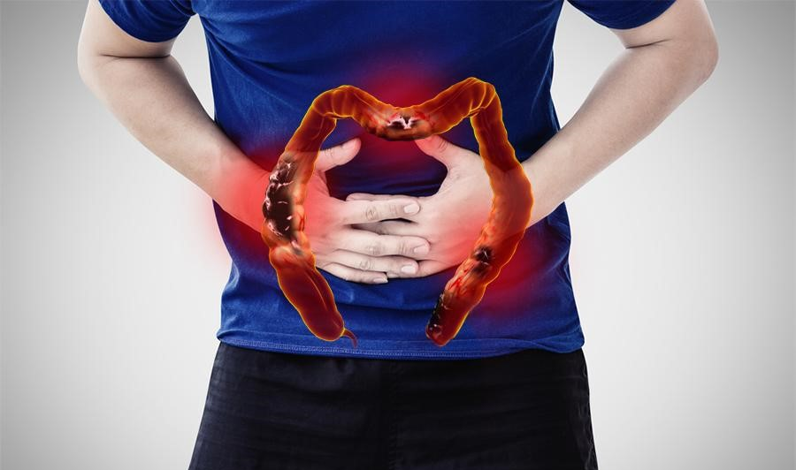 Bài thuốc trị chứng đại tràng thấp nhiệt