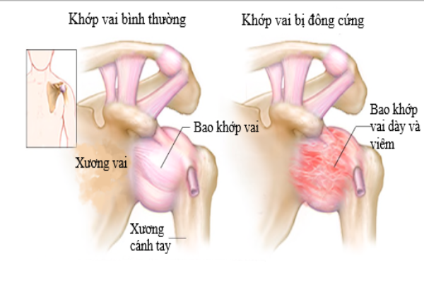 Đối phó với chứng đông cứng khớp vai