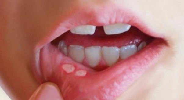 Vì sao hay bị viêm loét miệng?