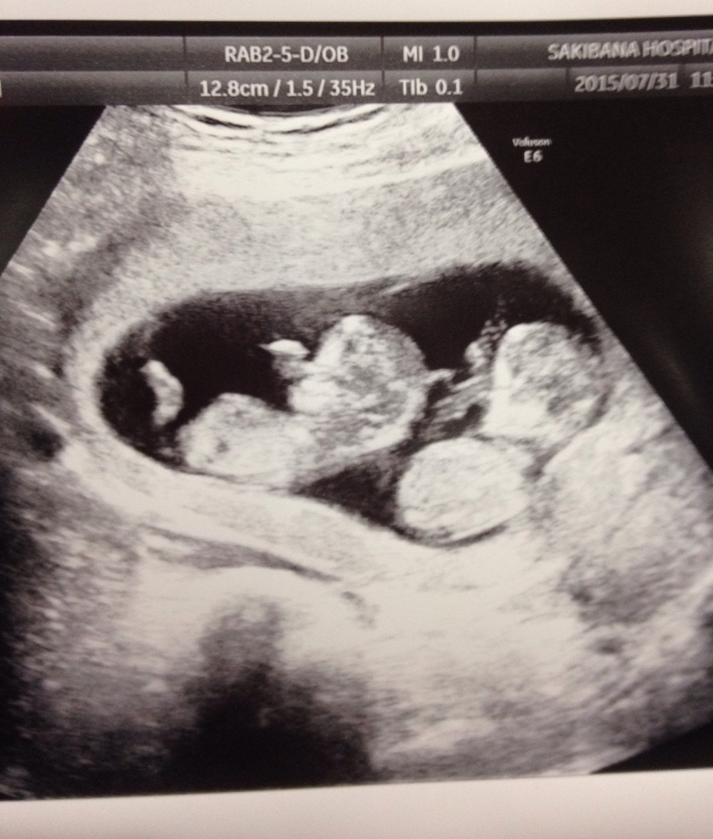Nếu bạn đang mang thai đa thai, việc siêu âm là một điều vô cùng quan trọng để tiên đoán và theo dõi sức khỏe của các em bé của bạn. Hãy xem hình ảnh đa thai siêu âm để hiểu thêm về quá trình này.