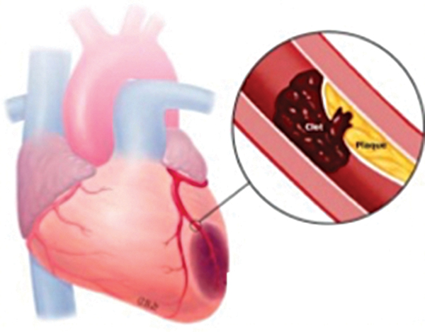 Những biểu hiện của bệnh động mạch vành