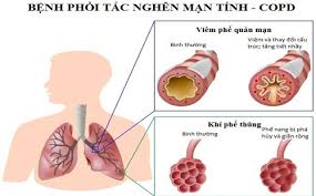 9 đối tượng dễ bị COVID -19 tấn công