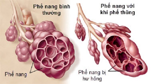 bệnh khí phế thũng