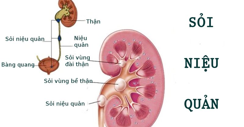 Sỏi niệu quản có nguy hiểm?