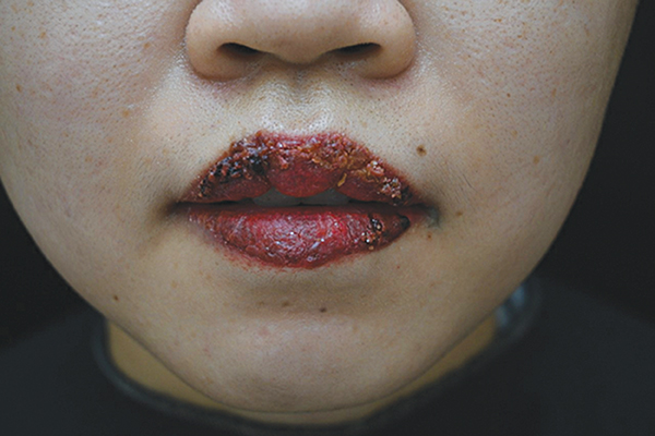 Cô gái bị nhiễm trùng do phun môi vì thợ phun đâm kim quá sâu