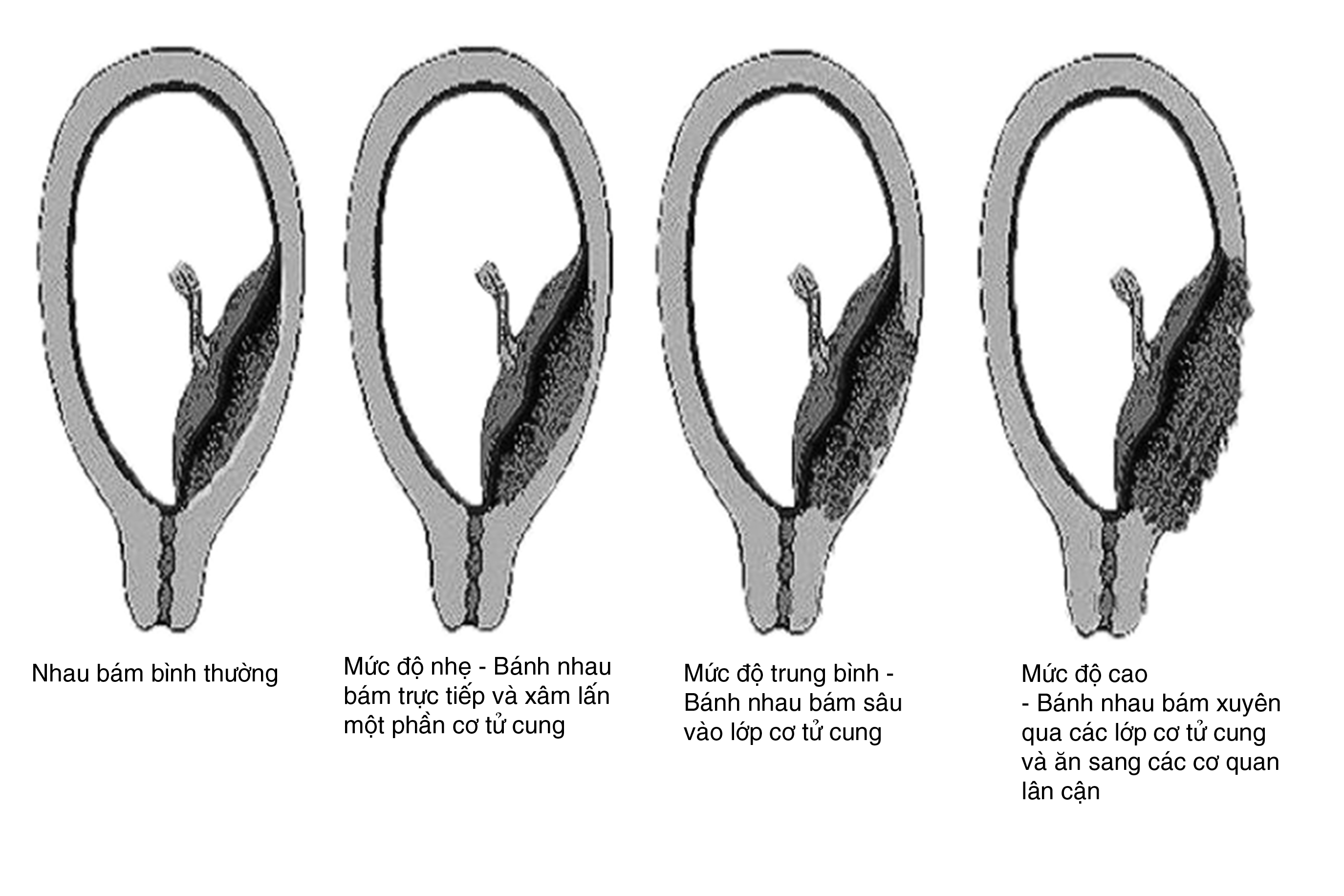 Nhau cài răng lược