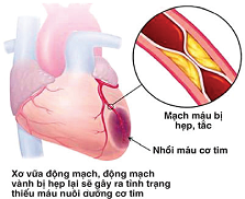 Bệnh tim mạch