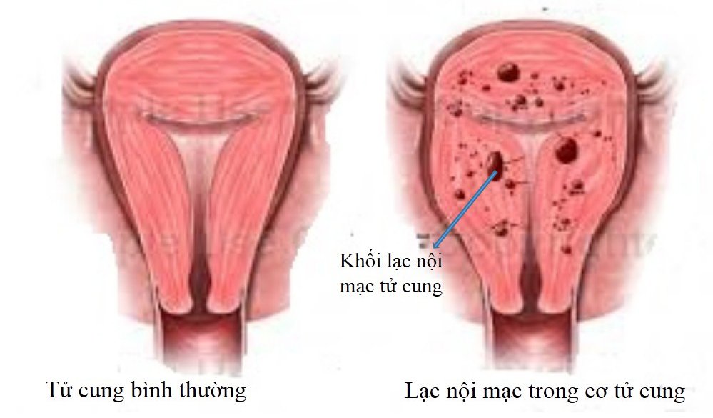 Khối Lạc Nội Mạc Tử Cung: Nguyên Nhân, Triệu Chứng Và Cách Điều Trị Hiệu Quả