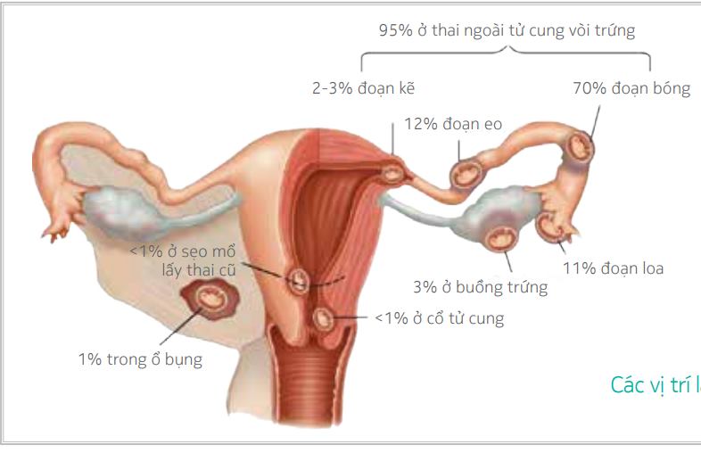 Thai bám sẹo mổ 