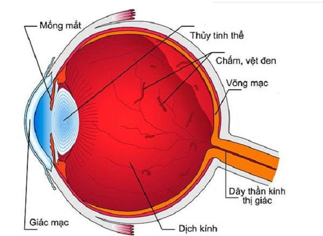  xuất huyết dịch kính