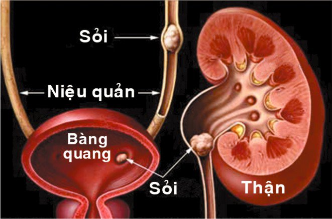 sỏi niệu quản