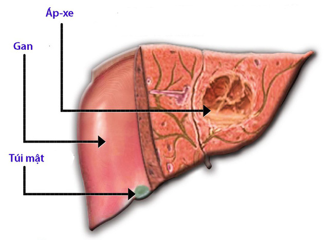 Áp-xe gan do amip có nguy hiểm?