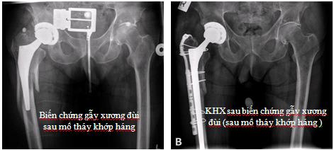 Biến chứng sau mổ thay khớp háng 