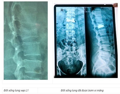 xẹp đốt sống