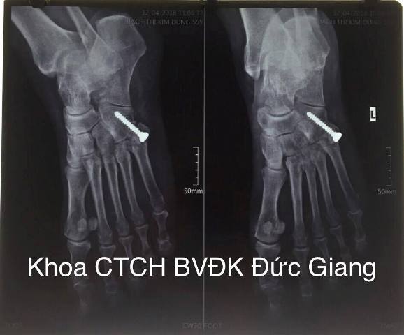 Cụ bà tự ý dùng thuốc corticoid suốt 20 năm khiến mặt tích nước ...