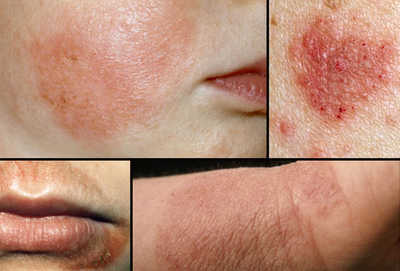 Bệnh eczema có chữa dứt điểm được không?