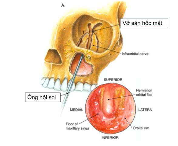 Vỡ Sàn Hốc Mắt Người Phụ Nữ đầu Tiên Tại Vn được Nội Soi Tái Tạo Hoàn Toàn Qua đường Miệng