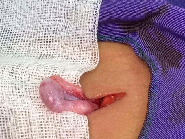 Tinh hoàn lạc chỗ ở trẻ, không chữa sớm dễ vô sinh