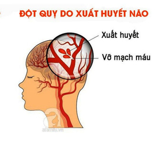 Đột Quỵ Chảy Máu Não: Nguyên Nhân, Triệu Chứng và Cách Điều Trị Hiệu Quả