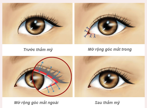 Buồn vì mắt híp liền đi mở góc mắt, không ngờ \