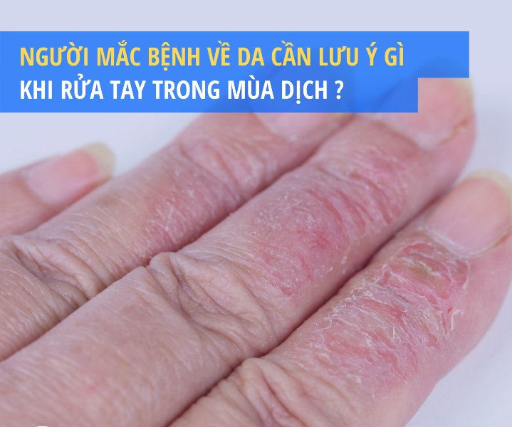 Các Bệnh Về Da Tay: Nguyên Nhân, Triệu Chứng Và Cách Điều Trị Hiệu Quả