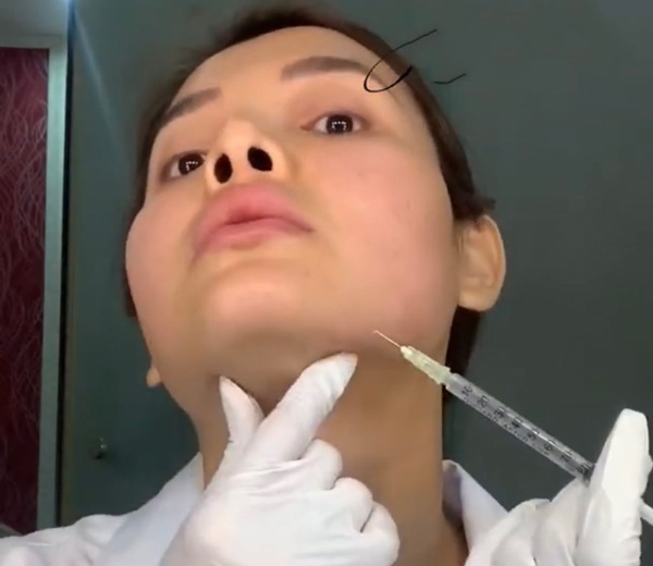 Tự tiêm filler như Phương Trinh Jolie, quá nguy hiểm !