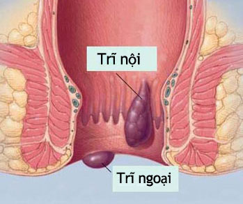 Các phương pháp điều trị bệnh trĩ ngoại