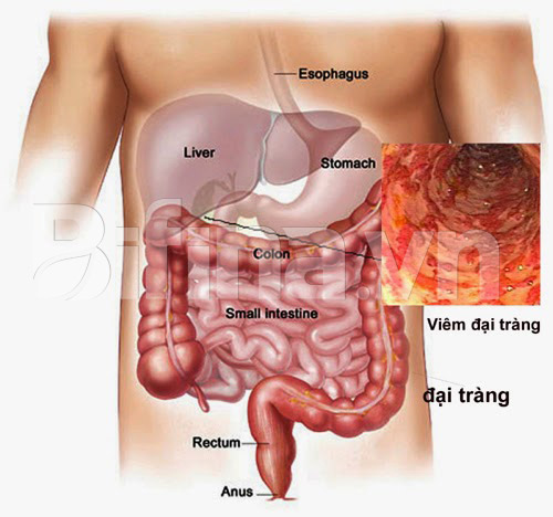 Thông Tin Chi Tiết về Viêm Đại Tràng Sôi Bụng