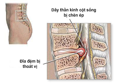 Điều trị thoát vị đĩa đệm cột sống như thế nào?