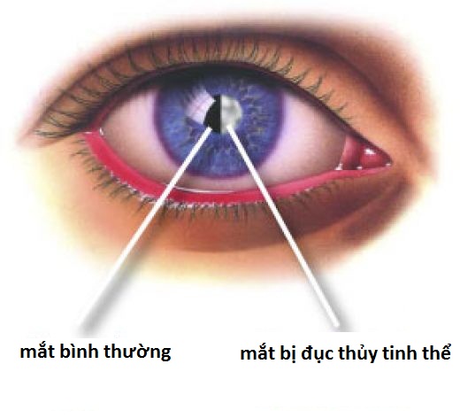 Đục Thủy Tinh Thể “sát Nhân” Của đôi Mắt 