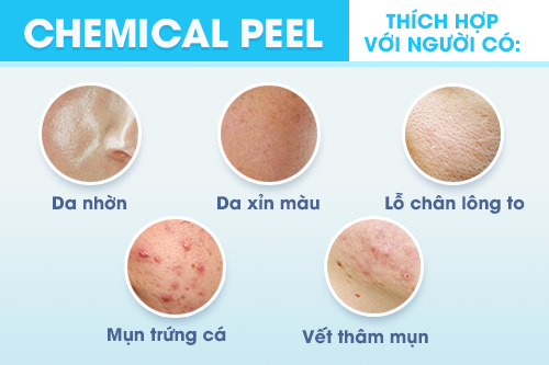 Những làn da nhờn, mụn, xỉn màu, lỗ chân lông to, vết thâm,... thích hợp thực hiện Chemical Peel (Peel da).