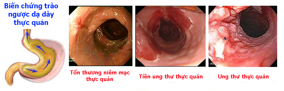 Trào ngược đêm – “nỗi đau” thêm dài