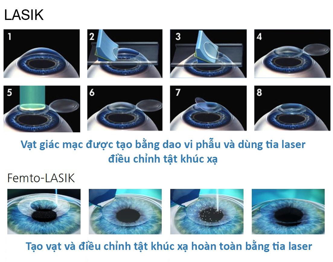 Ластик зрение. Коррекция зрения методом ласик. Лазерная коррекция зрения Femto ласик. Лазерная коррекция методом Femto LASIK. Ласик (LASIK)/Фемто ласик (Femto LASIK).