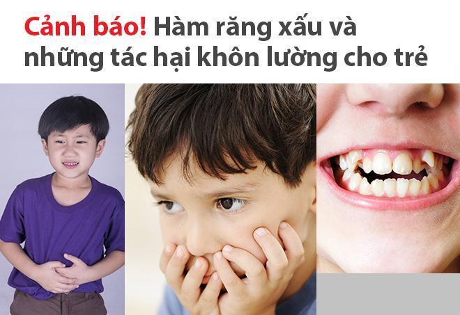 Sở hữu nụ cười tươi tắn và rạng rỡ với điều trị đặc biệt cho răng hô xấu. Hình ảnh này sẽ thổi bay nỗi lo của bạn về vấn đề này và trở thành cơ hội để có một hàm răng hoàn hảo.